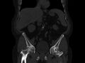 Ankylosing spondylitis (Radiopaedia 44609-48357 Coronal bone window 22).jpg