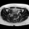 Ano-vaginal fistula (Radiopaedia 29765-30284 Axial T2 23).jpg