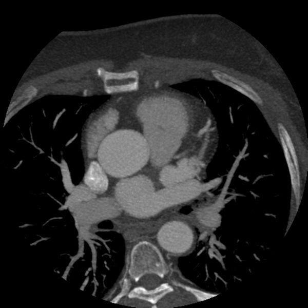 File:Anomalous origin of left circumflex artery from right coronary sinus (Radiopaedia 72563-83117 A 47).jpg