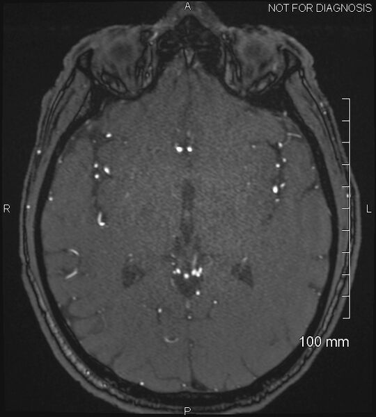 File:Anterior cerebral artery aneurysm (Radiopaedia 80683-94127 Axial MRA 120).jpg