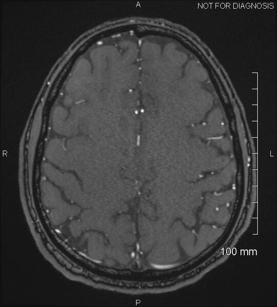 File:Anterior cerebral artery aneurysm (Radiopaedia 80683-94127 Axial MRA 188).jpg