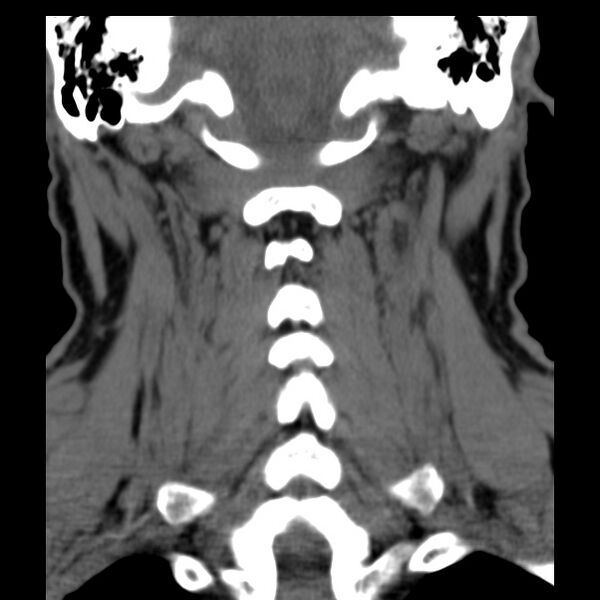 File:Anterior cervical postdiscectomy arthrodesis (Radiopaedia 32678-33646 Coronal non-contrast 25).jpg