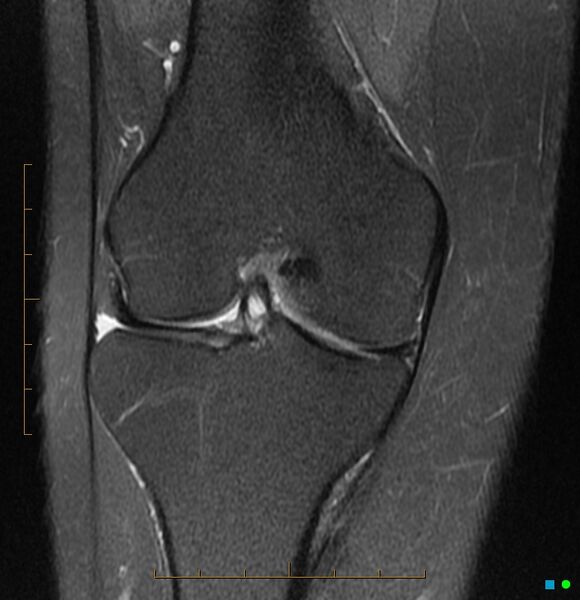 File:Anterior cruciate ligament ganglion cyst (Radiopaedia 3582-6491 Coronal PD fat sat 1).jpg