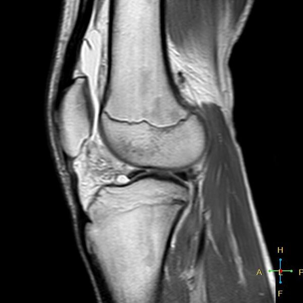 File:Anterior cruciate ligament tear - complete (Radiopaedia 24907-25170 Sagittal PD 6).jpg