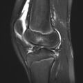 Anterior cruciate ligament tear - pediatric (Radiopaedia 62152-70260 Sagittal PD fat sat 22).jpg