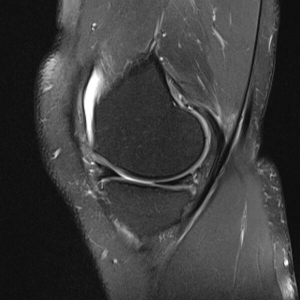 File:Anterior cruciate ligament tear - ramp lesion (Radiopaedia 71883-82322 Sagittal PD fat sat 19).jpg