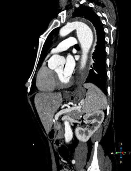 File:Aortic aneurysm and penetrating ulcer (Radiopaedia 23590-23704 C 5).jpg