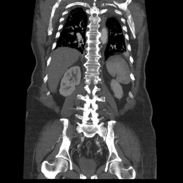 File:Aortic dissection (Radiopaedia 28802-29105 B 30).jpg
