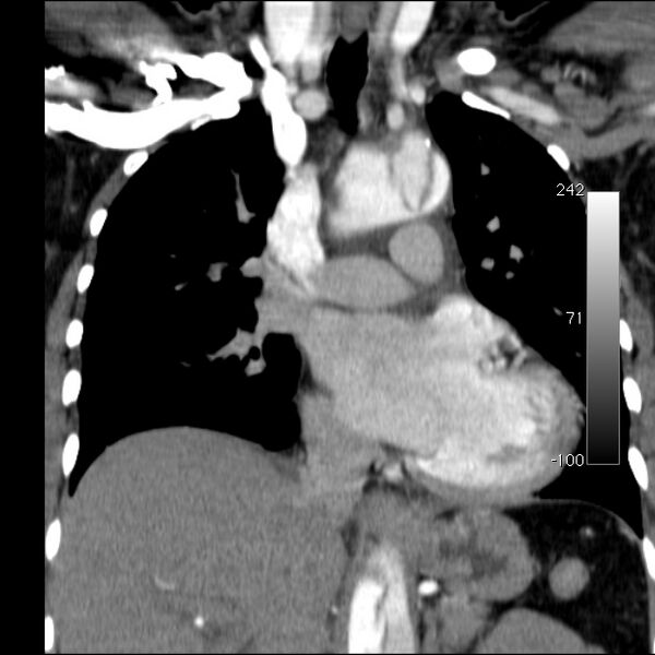 File:Aortic dissection - Stanford type A (Radiopaedia 29247-29659 B 30).jpg
