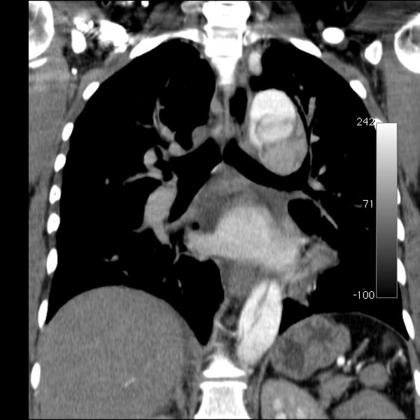 File:Aortic dissection - Stanford type A (Radiopaedia 29247-29659 B 37).jpg