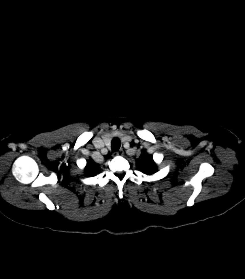 Aortic dissection with renal ischemia (Radiopaedia 76573-88338 B 2).jpg