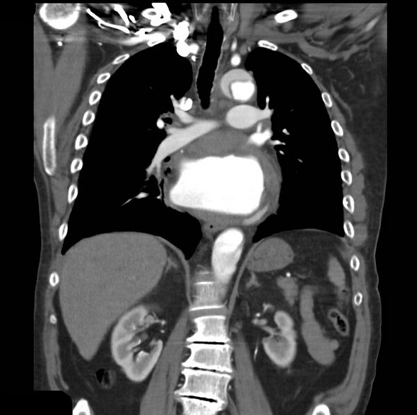 File:Aortic dissection with rupture into pericardium (Radiopaedia 12384-12647 B 24).jpg