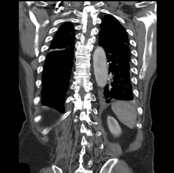 File:Aortic dissection with rupture into pericardium (Radiopaedia 12384-12647 B 36).jpg
