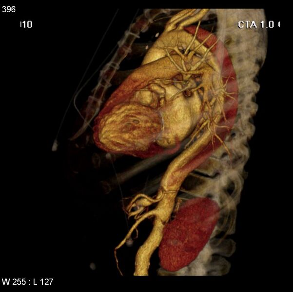 File:Aortic dissection with rupture into pericardium (Radiopaedia 12384-12647 C+ arterial phase 28).jpg