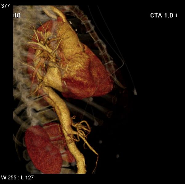 File:Aortic dissection with rupture into pericardium (Radiopaedia 12384-12647 C+ arterial phase 9).jpg