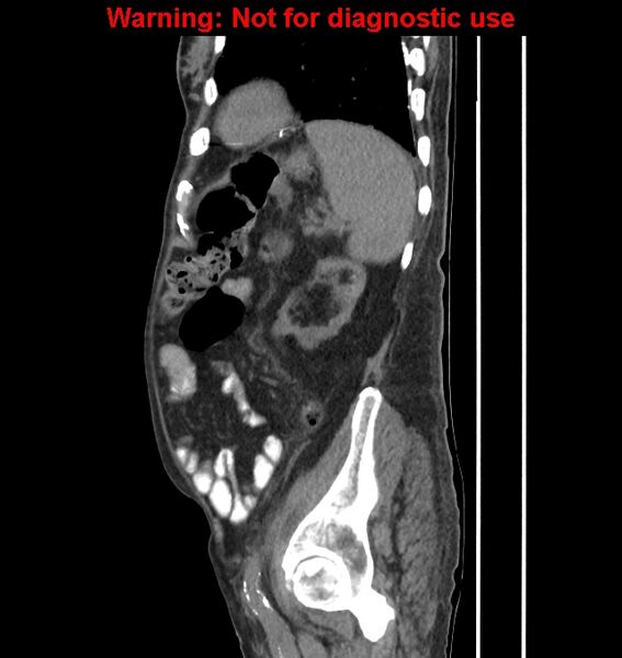 File:Aortic graft infection (Radiopaedia 44979-48907 C 18).jpg