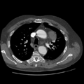 Aorto-coronary bypass graft aneurysms (Radiopaedia 40562-43157 A 37).png