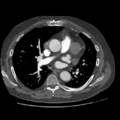 Aorto-coronary bypass graft aneurysms (Radiopaedia 40562-43157 A 56).png