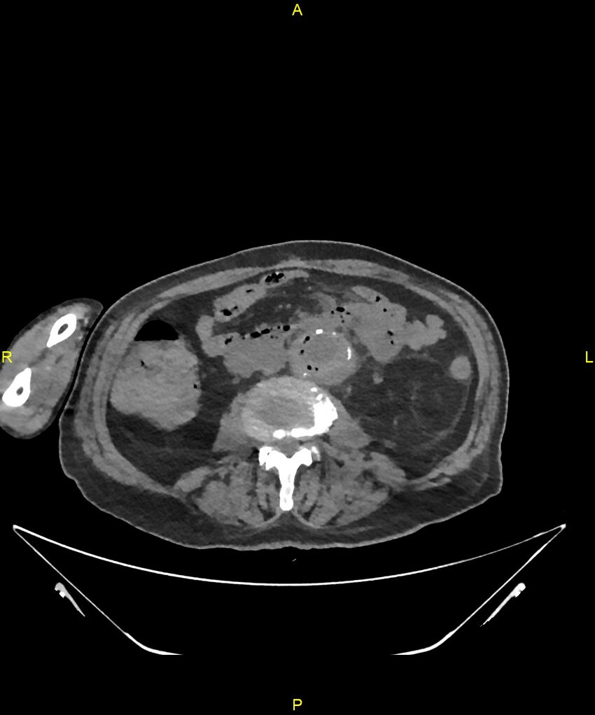 Aortoenteric fistula (Radiopaedia 84308-99603 Axial non-contrast 193).jpg
