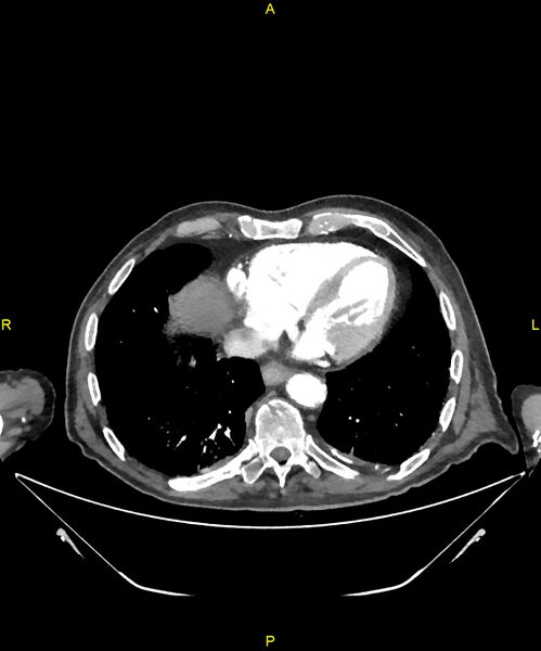 File:Aortoenteric fistula (Radiopaedia 84308-99603 B 4).jpg