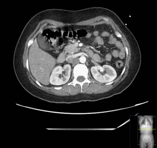 File:Appendicitis (CT angiogram) (Radiopaedia 154713-127660 Axial 131).jpg