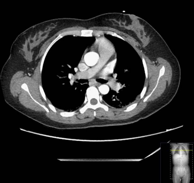 File:Appendicitis (CT angiogram) (Radiopaedia 154713-127660 Axial 206).jpg