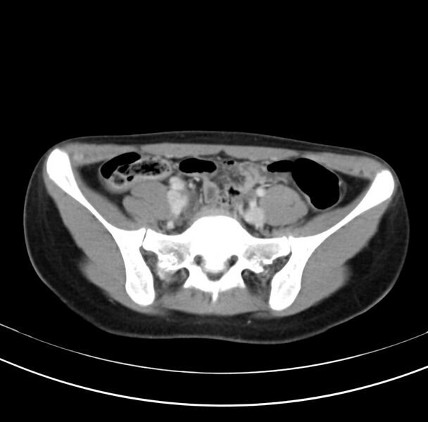 File:Appendicitis and incidental bicornuate uterus (Radiopaedia 22833-22853 B 33).jpg