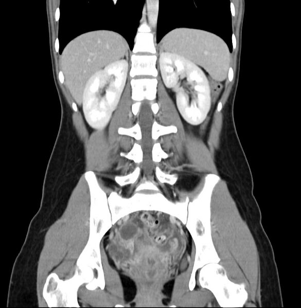 File:Appendicitis and incidental bicornuate uterus (Radiopaedia 22833-22853 D 29).jpg