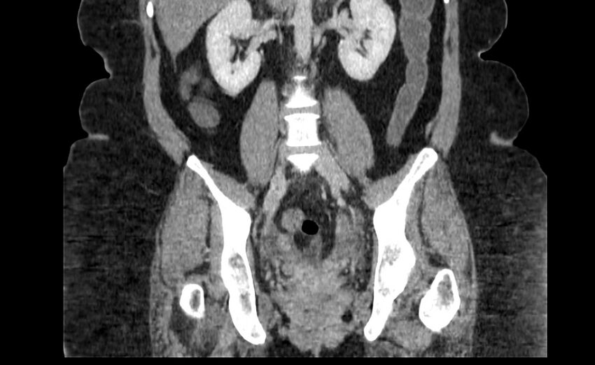 Appendix mucocele (Radiopaedia 41222-44033 B 56).jpg