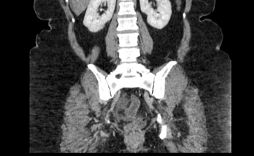 Appendix mucocele (Radiopaedia 41222-44033 B 68).jpg