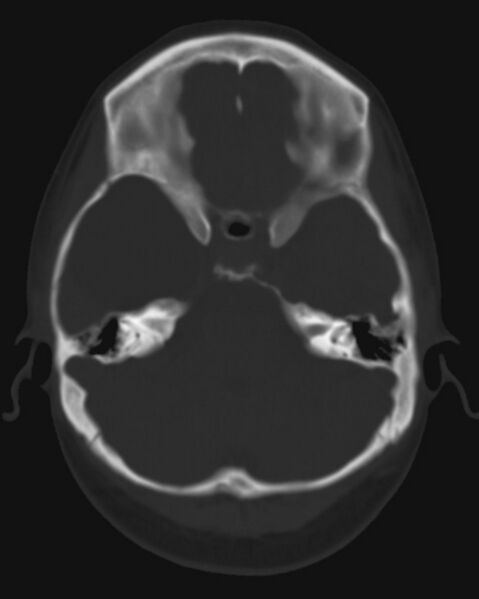 File:Arachnoid cyst - middle cranial fossa (Radiopaedia 2581-6274 Axial bone window 1).jpg