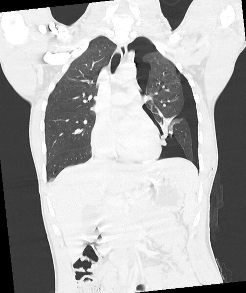 File:Arrow injury to the chest (Radiopaedia 85367-100975 Coronal lung window 70).jpg