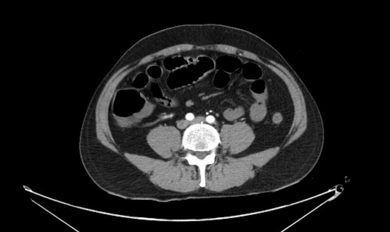File:Arterial occlusive mesenteric ischemia (Radiopaedia 84641-100060 A 84).jpg