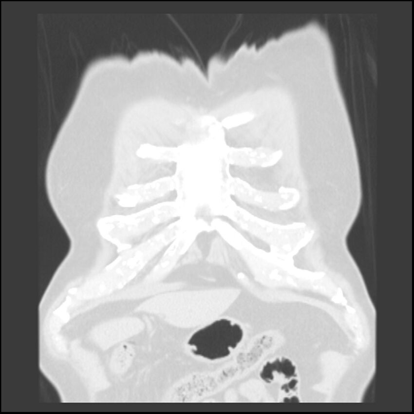 Asbestos-related pleural plaques (Radiopaedia 39069-41255 Coronal lung window 82).jpg