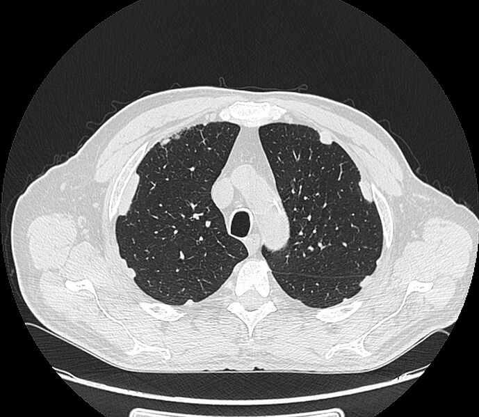 File:Asbestos pleural placques (Radiopaedia 57905-64872 Axial lung window 68).jpg