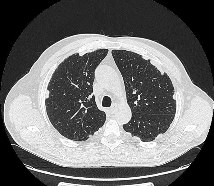 File:Asbestos pleural placques (Radiopaedia 57905-64872 Axial lung window 87).jpg