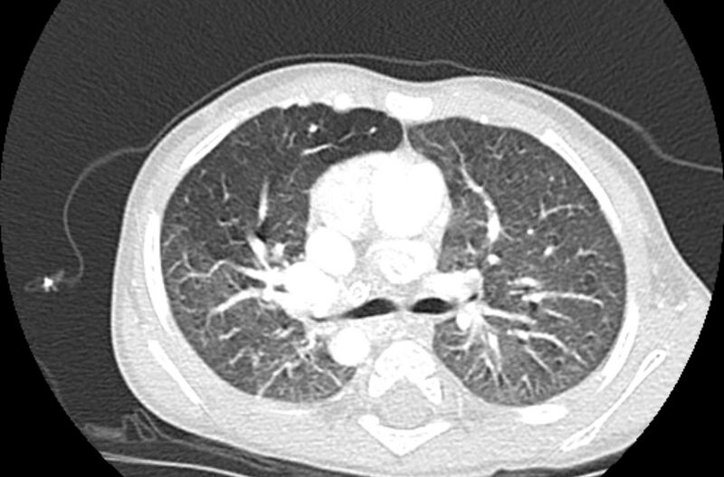 File:Asplenia syndrome (Radiopaedia 73083-83792 Axial lung window 26).jpg