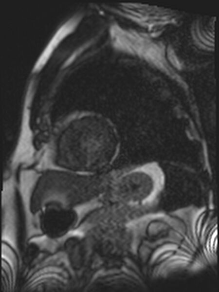 File:Asymmetric septal hypertrophic cardiomyopathy - systolic anterior motion of mitral leaflet (Radiopaedia 72795-83445 E 7).jpg
