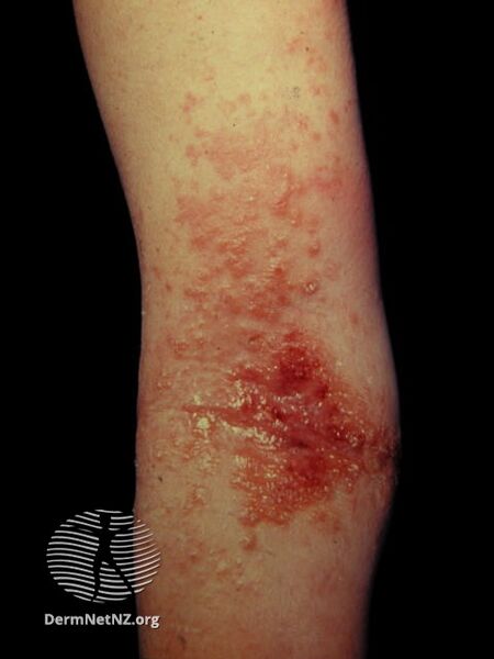 File:Atopic dermatitis (DermNet NZ dermatitis-flexural-eczema10).jpg