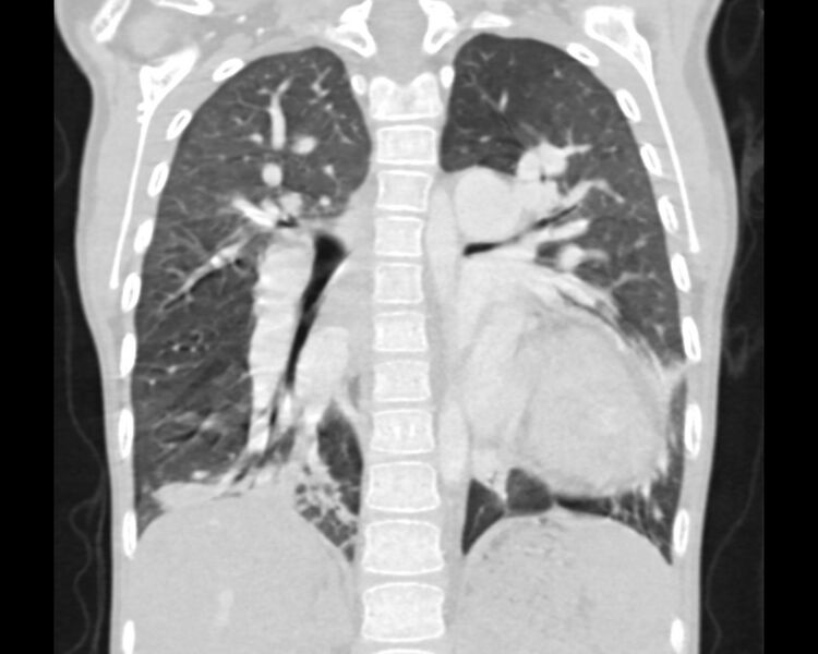 File:Atrial septal defect complicated by Eisenmenger syndrome (Radiopaedia 53707-59768 Sagittal lung window 16).jpg