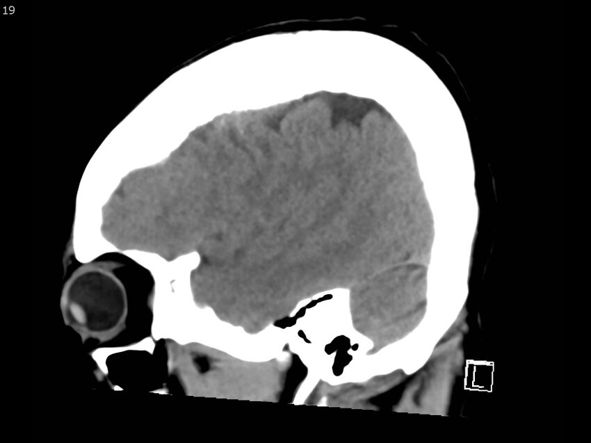 Atypical meningioma - intraosseous (Radiopaedia 64915-73867 C 17).jpg