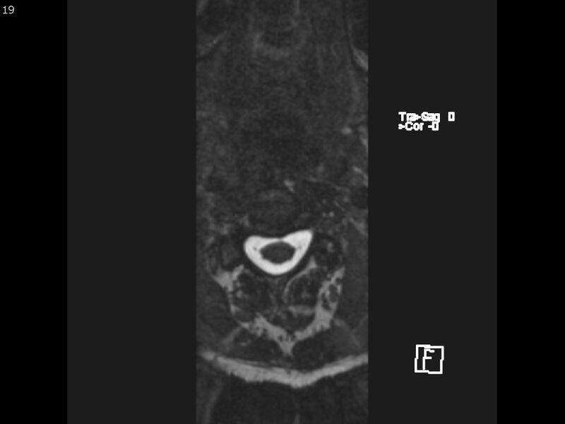 File:Atypical meningioma - intraosseous (Radiopaedia 64915-74572 Axial CISS 19).jpg