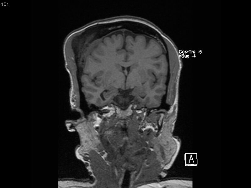 File:Atypical meningioma - intraosseous (Radiopaedia 64915-74572 Coronal T1 101).jpg