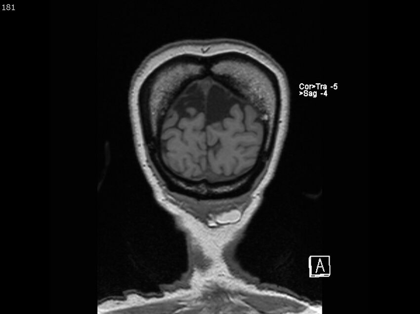 Atypical meningioma - intraosseous (Radiopaedia 64915-74572 Coronal T1 181).jpg
