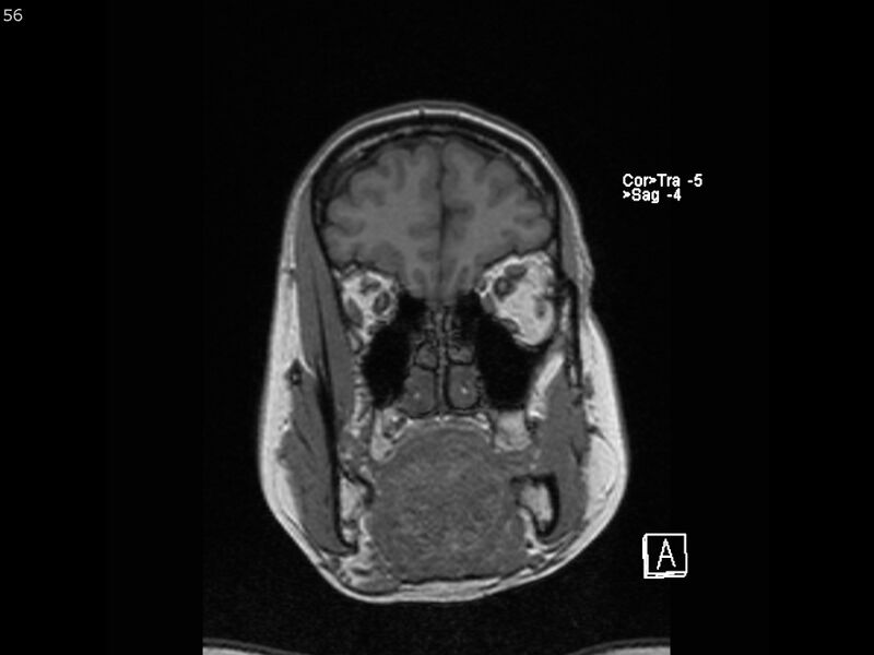File:Atypical meningioma - intraosseous (Radiopaedia 64915-74572 Coronal T1 56).jpg