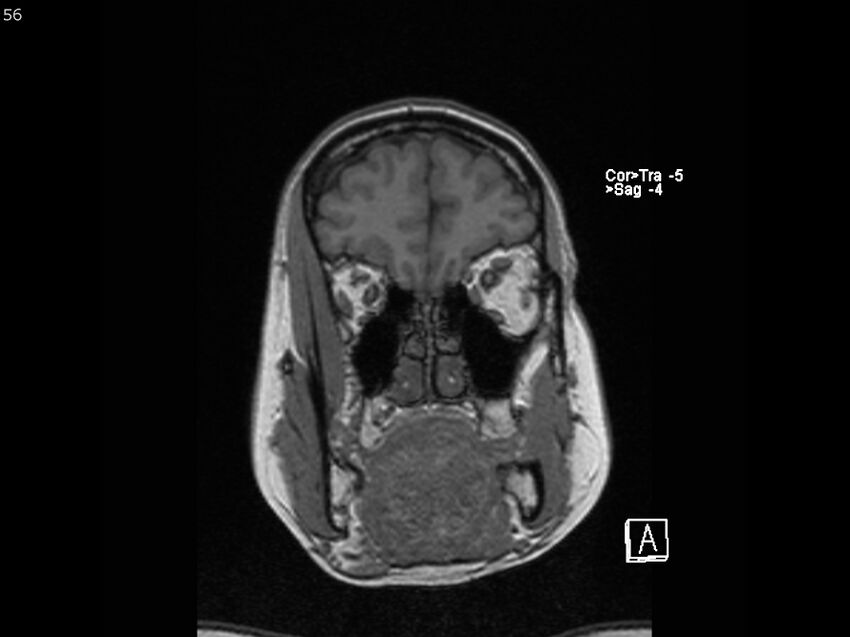 Atypical meningioma - intraosseous (Radiopaedia 64915-74572 Coronal T1 56).jpg