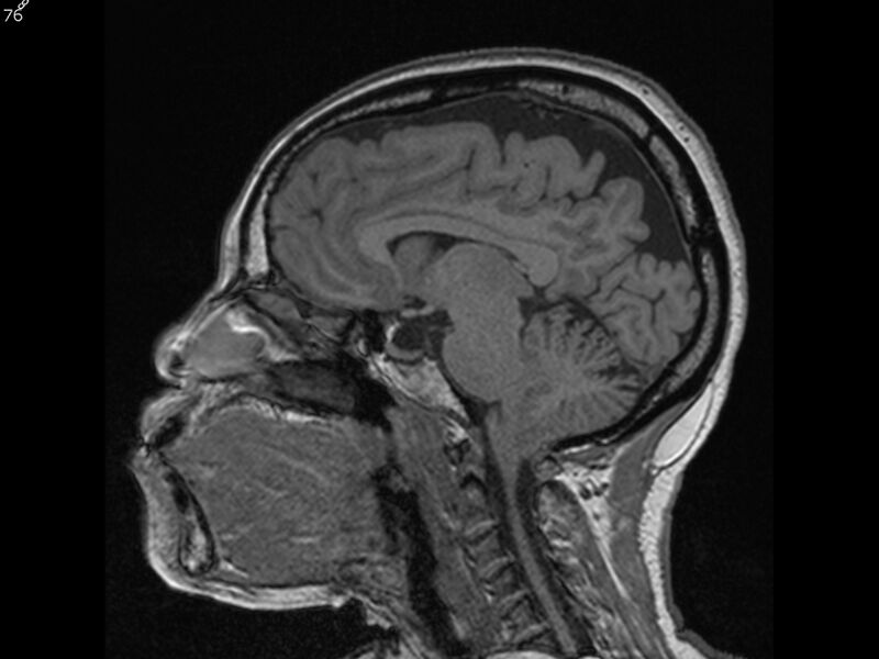 File:Atypical meningioma - intraosseous (Radiopaedia 64915-74572 Sagittal T1 76).jpg