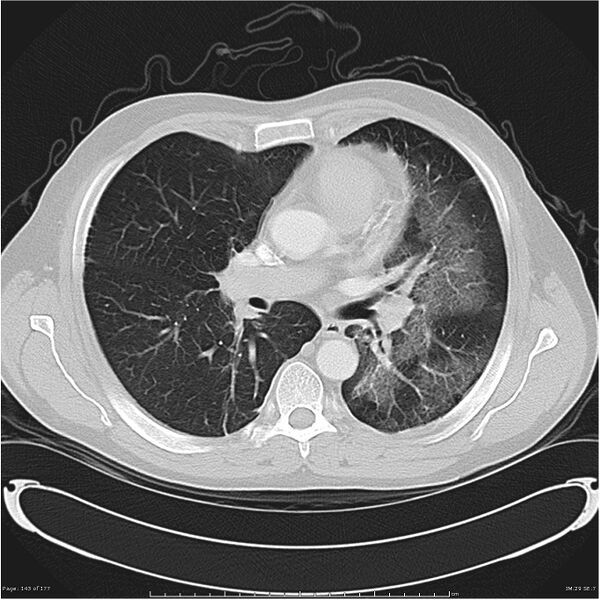 File:Atypical pneumonia - Q fever (Radiopaedia 21993-21989 lung window 22).jpg