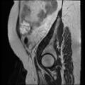Atypical retroperitoneal lymphocoeles with large leiomyoma of uterus (Radiopaedia 32084-33027 Sagittal T2 29).jpg