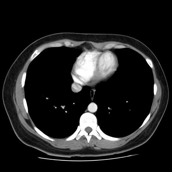 File:Autosomal dominant polycystic kidney disease (Radiopaedia 23061-23093 B 3).jpg